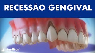 Recessão gengival  Tratamento da retração da gengiva © [upl. by Mandal]