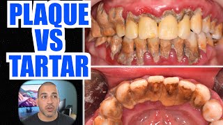 Plaque Vs Tartar  How to Remove Plaque on Teeth amp STOP Dental Calculus [upl. by Yenahc709]