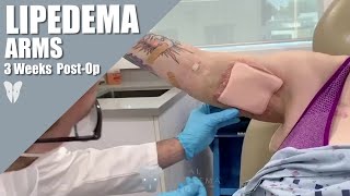 Lipedema Reduction Surgery Arms  Patient FollowUp  Liposuction amp Manual Lipedema Extraction [upl. by Alma]