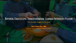 Paos Biportal Endoscopic Transforaminal Lumbar Interbody Fusion BETLIF using Double Cages [upl. by Caldera]