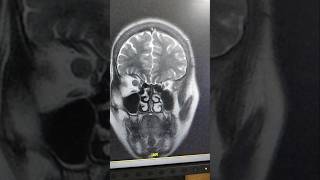 Optic Nerve Glioma [upl. by Tomlinson]