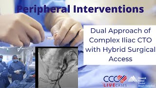 Dual Approach of Complex Iliac CTO with Hybrid Surgical Access [upl. by Airbmat795]