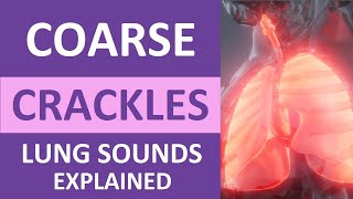 Coarse Crackles Lung Sounds Audio Causes Auscultation Nursing NCLEX Review [upl. by Stephanus]