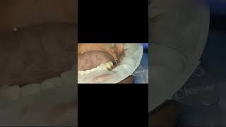 Multiple basal dental implants  g cam milled partial prosthesis fitting video shorts [upl. by Auria]