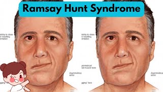 Understanding Ramsay Hunt Syndrome Symptoms and Treatment Explained [upl. by Euqinobe]