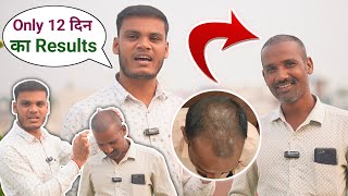 Hair Transplant Results Raipur Chhattisgarh  FUE Hair Transplant Clinic in Raipur Chhattisgarh cg [upl. by Ivatts958]