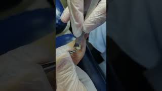 Pedicure Tutorial：Plantar wart on the little finger carefully treated with tools 【FanYi】 [upl. by Rivard]