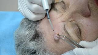 Intra dermal nevus  removal by highfrequency electrosurgery [upl. by Onibla]