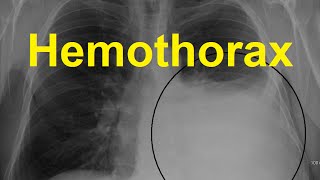 Hemothorax Symptoms Causes and Treatment [upl. by Nalyad]