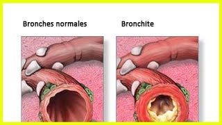 Traitement naturel de la bronchite [upl. by Small]