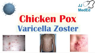 Chickenpox  Varicella Zoster Virus  Pathogenesis Signs and Symptoms Diagnosis and Treatment [upl. by Eelatsyrc22]