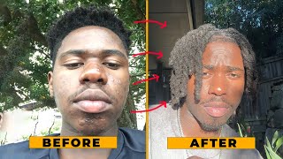 How I FINALLY Got Rid of My Acne [upl. by Denoting850]