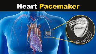 How Heart Pacemaker works UrduHindi [upl. by Yauqram]