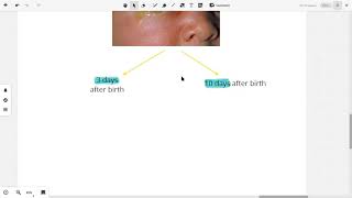 Bacterial Conjunctivitis 2 [upl. by Otrepur]