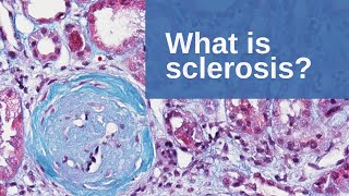 What is Sclerosis  Pathology mini tutorial [upl. by Idelle]