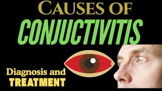 Understanding Conjunctivitis Causes Symptoms and Treatments [upl. by Taro996]