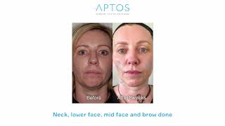 Aptos Thread Lift Visage Excellent Method [upl. by Annenn]