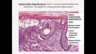 Lecture57 Inherited disorders of cornification Part 3 Nonsyndromic keratodermas Rooks ch 65 [upl. by Clemen746]