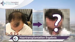 Haartransplantation Vorher Nachher  Ergebnis nach 12 Monaten [upl. by Jasun621]