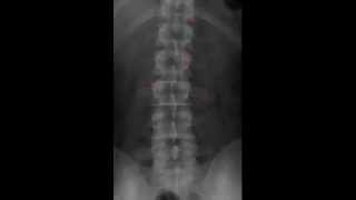 Lumbar Spine Radiology Tutorial [upl. by Agosto136]