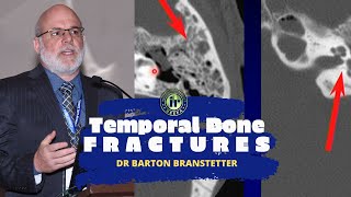 TMT Temporal Bone Fractures by Dr Barton Branstetter [upl. by Dorene708]