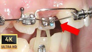 ❤️‍🔥 PIGGYBACK step by step double wire technique and ODONTOMA in Crossbite Case 4K Video [upl. by Eelyab]