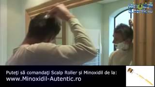 Cum se foloseste Scalp Roller cu Minoxidil [upl. by Tdnarb754]