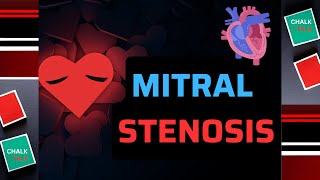 Mitral Valve Stenosis [upl. by Ecnaled916]