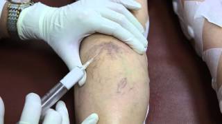 sclerotherapy 혈관경화요법 by Young Ki ShimMD [upl. by Ennyleuqcaj992]