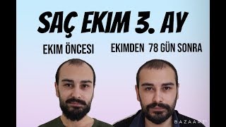 SAÇ EKİMİ 3 AY SAÇLAR UZAMAYA BAŞLADI  VİDEO 5 [upl. by Yrrab]