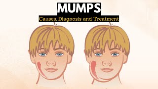 Mumps Causes Signs and Symptoms Diagnosis and Treatment [upl. by Leryt]