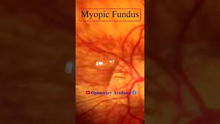 Myopic Fundus  Fundus Photography  Myopic Crescent  Short Video 141 viral optometryacademy [upl. by Raymonds]