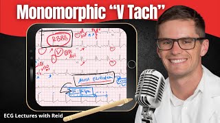 Monomorphic Ventricular Tachycardia VT EKG  ECG Lecture [upl. by Cianca]