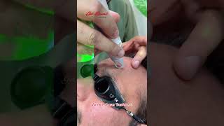 Wrinkles Laser Treatment getsmarthairclub skincare [upl. by Nelg]