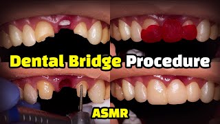 Dental Bridge Procedure [upl. by Ruthven142]