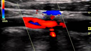 Internal Carotid Occlusion with Recanalizationwmv [upl. by Essyle500]