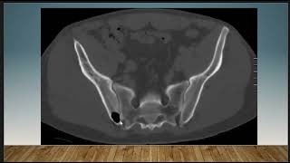 Short Case Discussion  Intraosseous pneumatocyst [upl. by Moersch]