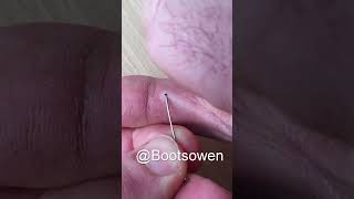 Try this one simple trick to remove a thorn from your finger Quick and easy for splinter extraction [upl. by Ojeillib]