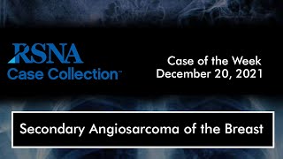 Case of the Week Secondary Angiosarcoma of the Breast [upl. by Ydnat505]