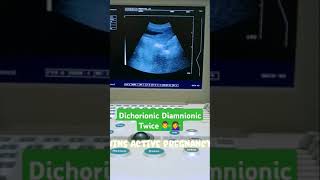 Dichorionic Diamnionic twins pregnancy 🥰🥰😍😍shortyoutubevideo plzzsubscribe babyultrasound [upl. by Rochette150]