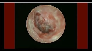 Keratosis Obturan Endoscopic Finding of The Ear Passage Before and After Cleaning [upl. by Micky]