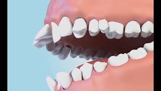 3D demonstration of buck teeth correction the feeling of seeing straight teeth orthodontics [upl. by Iamhaj766]