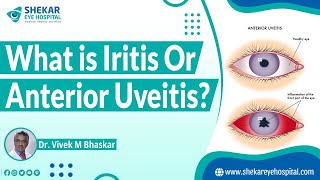 Iritis  Anterior Uveitis  Shekar Eye Hospital [upl. by Iralav]