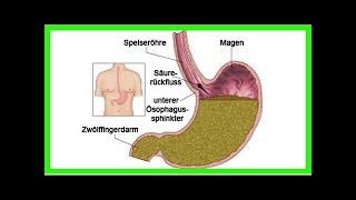 Sodbrennen – Behandlungsmöglichkeiten [upl. by Eyllib]