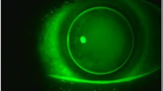 Multifocal GP Contact Lenses Video 3 [upl. by Noakes566]