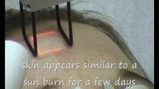 Fractional CO2 laser treatment Norwich Norfolk UK [upl. by Auqenehs68]