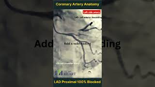 100 Blocked Proximal LAD Artery  Coronary Anatomy Overview FitMyHeart [upl. by Anse]