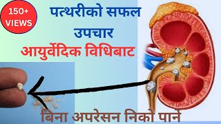 Kidney stone treatment in nepal [upl. by Ayian]