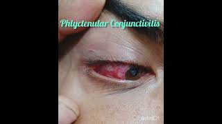 Phlyctenular Conjunctivitis department of Ophthalmology conjunctivitis [upl. by Efram899]