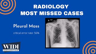 Most Missed Cases Pleural Mass [upl. by Aliab]